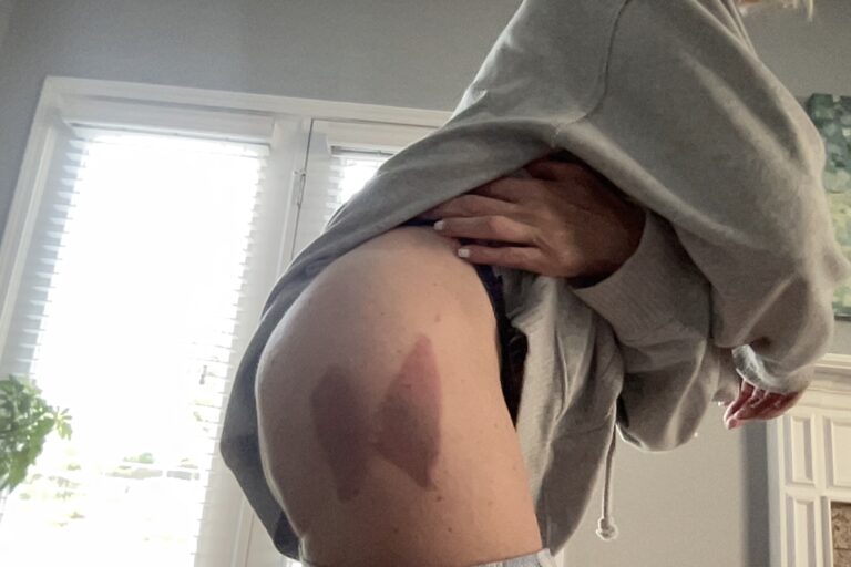 A large, dark bruise on a thin woman’s hip, photographed as documentation of physical trauma during a mental health hospitalization.